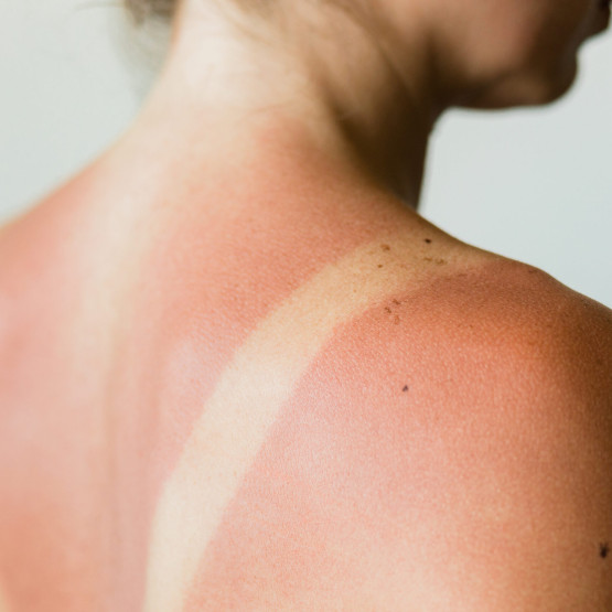 Close-up of a sunburn marks on a woman's back