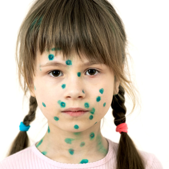 Różyczka u dzieci - objawy i leczenie