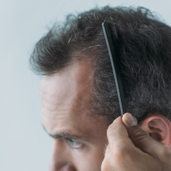 Wypadanie włosów – znane sposoby na łysienie