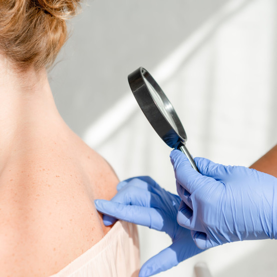 Nowotwory skóry - rozpoznanie, rodzaje i metody leczenia