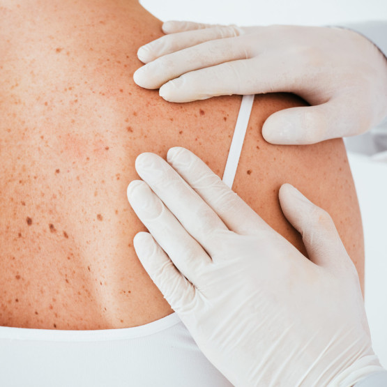 Leczenie nowotworów skóry - przegląd metod