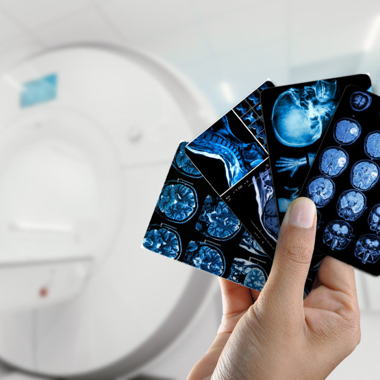 Tecfidera - zaczynam przygodę z leczeniem [BLOG]